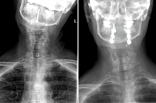 before and after x-rays of neck